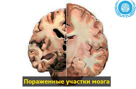 Глиоз мозга последствия. Глиоз артерий головного мозга. Кистозно-глиозные изменения головного мозга что это. Глиозные очаги головного мозга. Глиозные изменения головного мозга что это такое.
