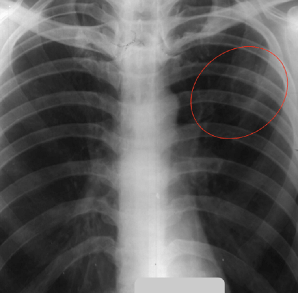 Туберкулез легкого рентгенограмма. Туберкулез ребер рентген. Туберкулез на снимке рентгена. Рентген легких туберкулез снимки.